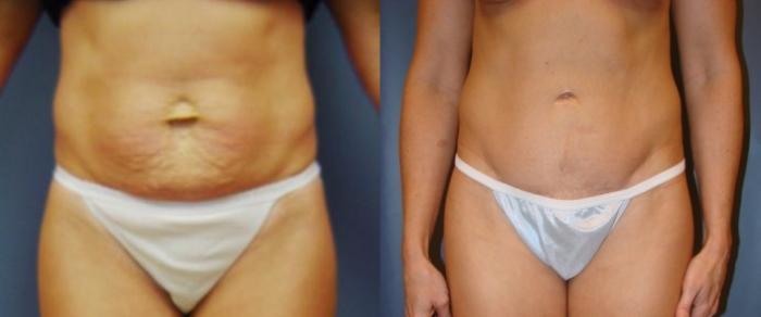 Before & After Tummy Tuck Case 59 View #1 View in Birmingham, AL