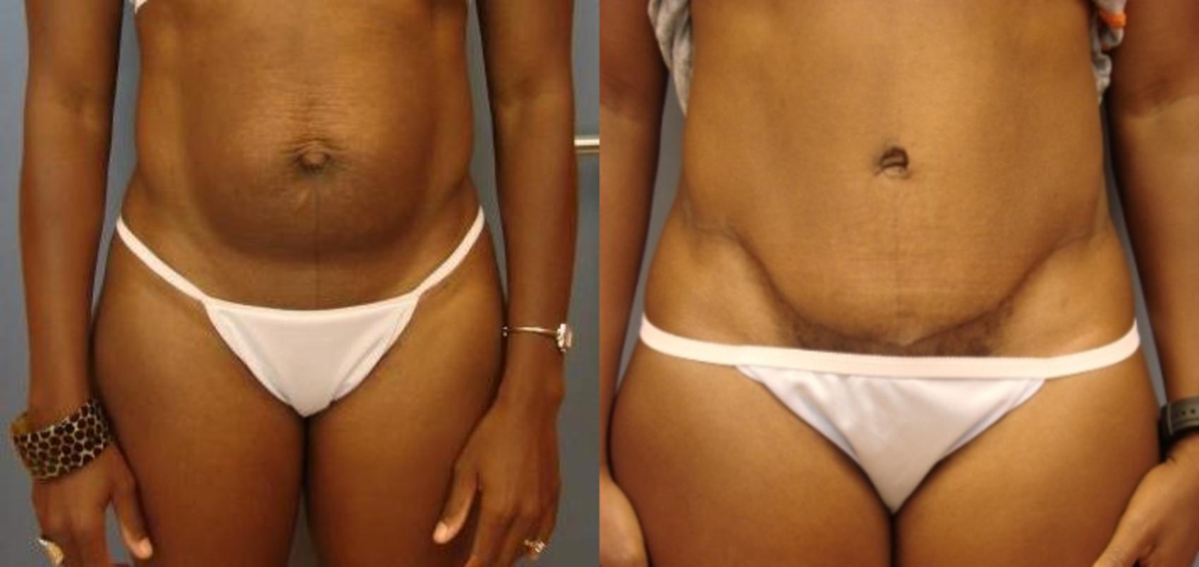 Before & After Tummy Tuck Case 60 View #1 View in Birmingham, AL