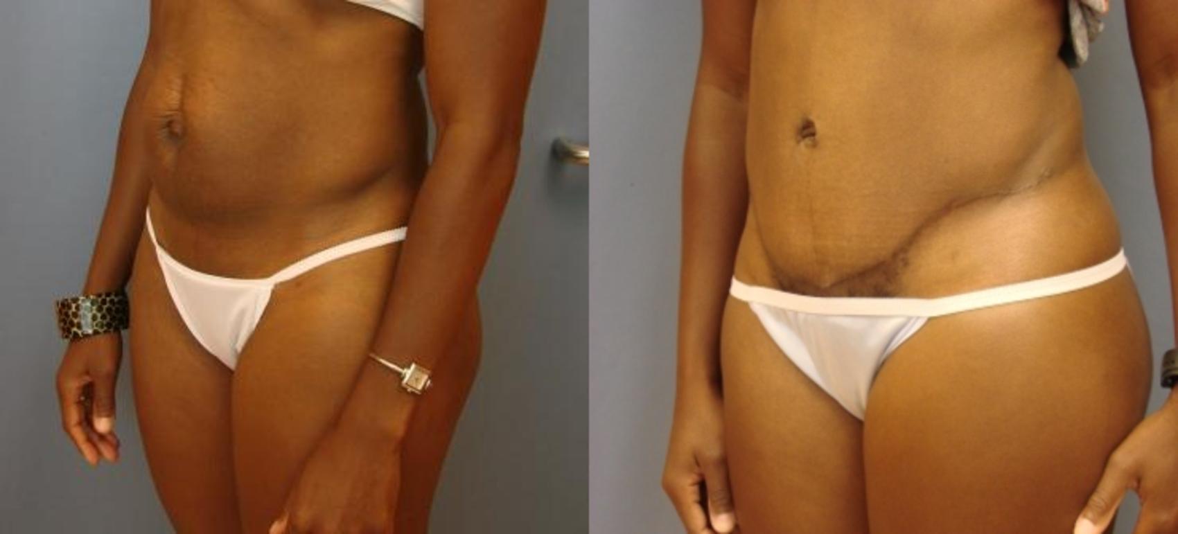 Before & After Tummy Tuck Case 60 View #2 View in Birmingham, AL