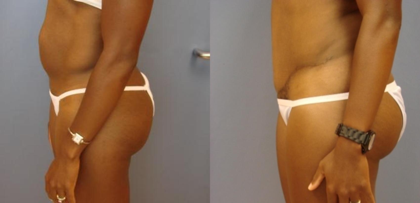 Before & After Tummy Tuck Case 60 View #3 View in Birmingham, AL
