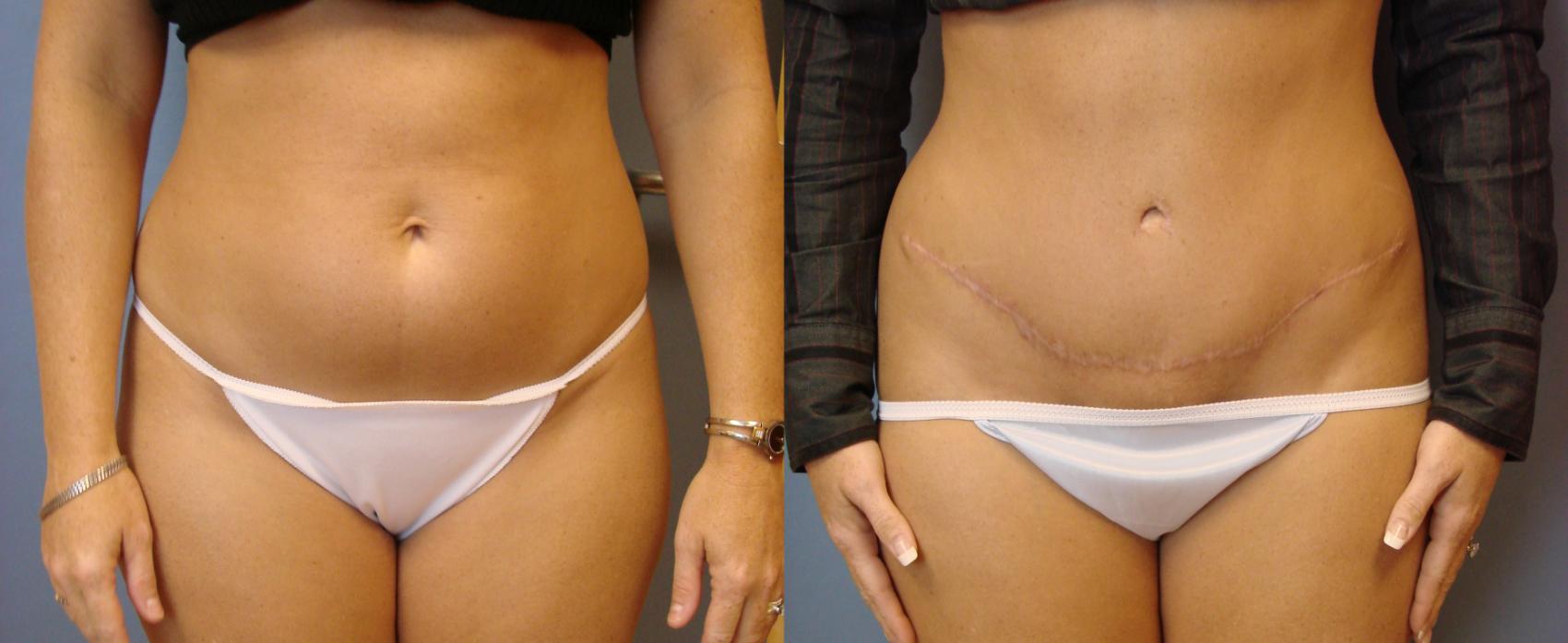 Before & After Tummy Tuck Case 71 View #1 View in Birmingham, AL