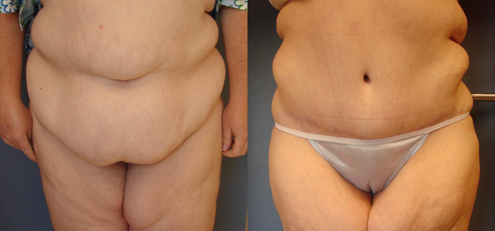 Before & After Tummy Tuck Case 72 View #1 View in Birmingham, AL